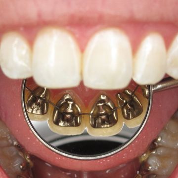 Clínica Dental Pinto brackets linguales